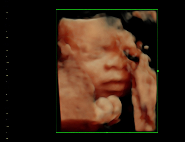 3D ultrasound image at 28 weeks
